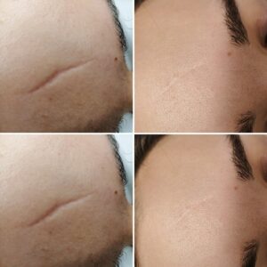 Laserowe usuwanie blizn i rozstępów