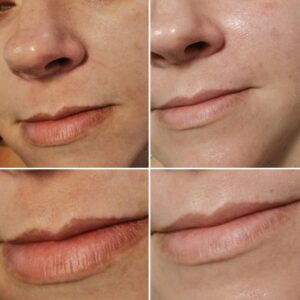 Laserowe usuwanie przebarwień