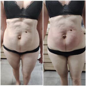 Fala radiowa na ciało